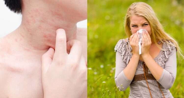 Allergy Ka Mukammal Ilaj