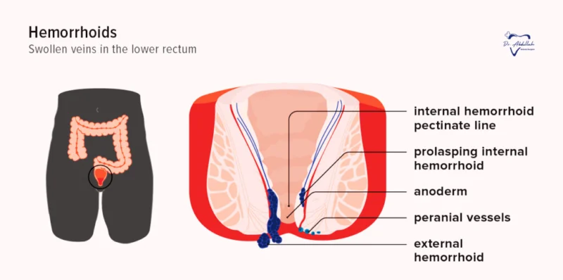 Symptoms and Causes of Bawaseer