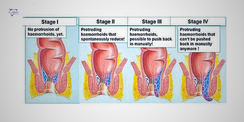 Symptoms and Causes of Bawaseer