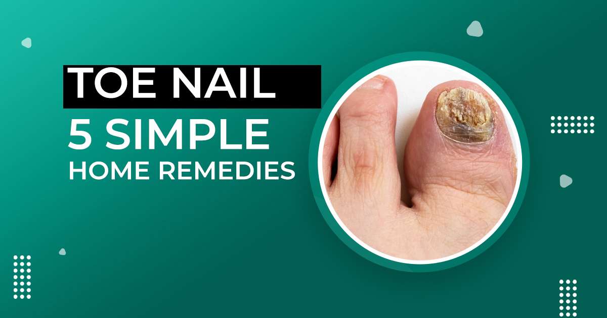 Ingrown Toenail 5 Simple Home Remedies