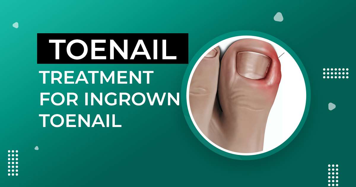 Treatment for ingrown Toenail