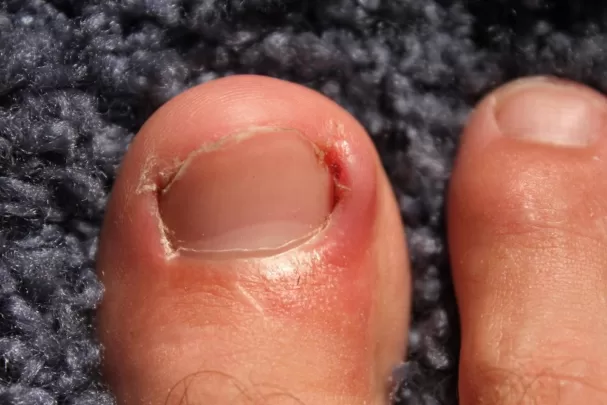 swelling of nail