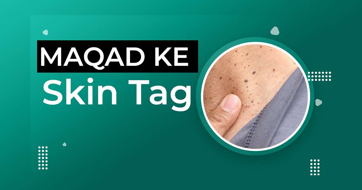 Maqad Ke Skin Tag