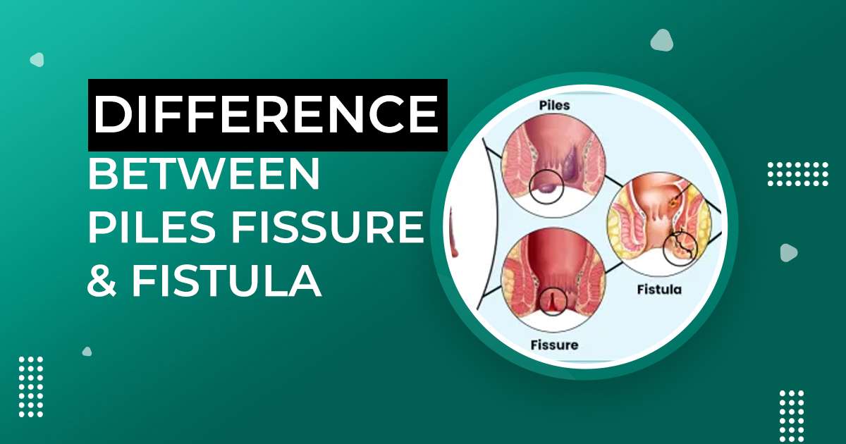 Difference Between Piles Fissure and Fistula