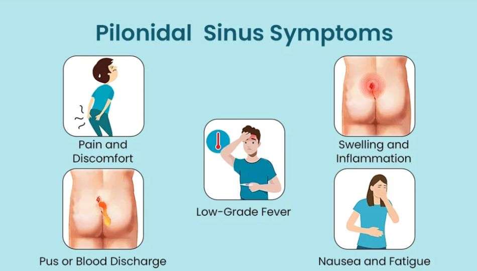 pilonidal sinus symptoms