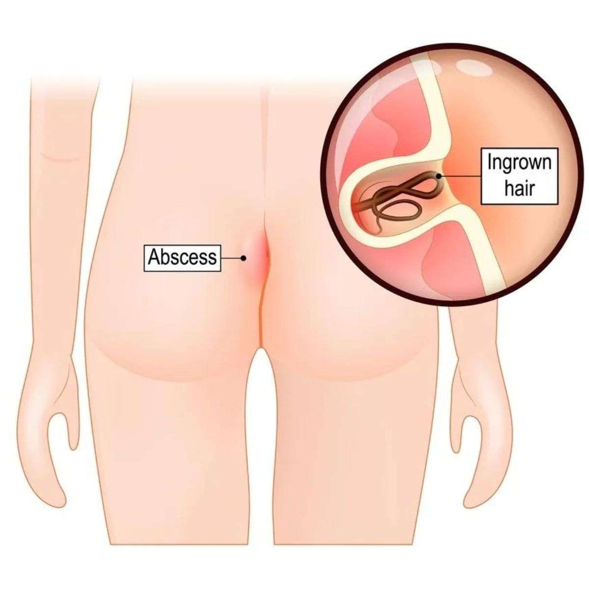 pilonidal sinus