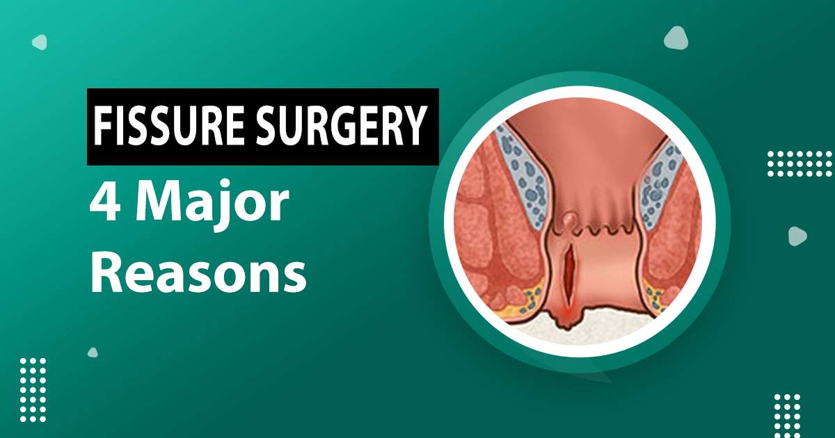 4 Major Reasons Of Anal Fissure Surgery