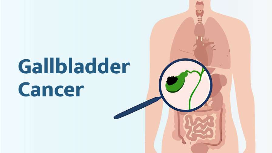 gallbladder cancer alamaaat