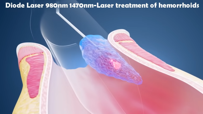 Laser Treatment for Hemorrhoids
