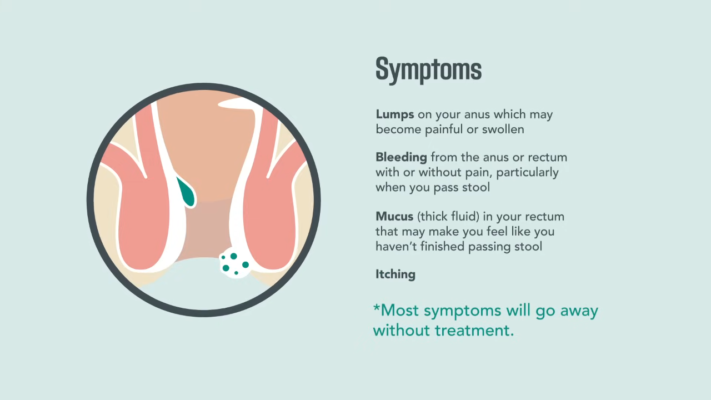 piles symptoms
