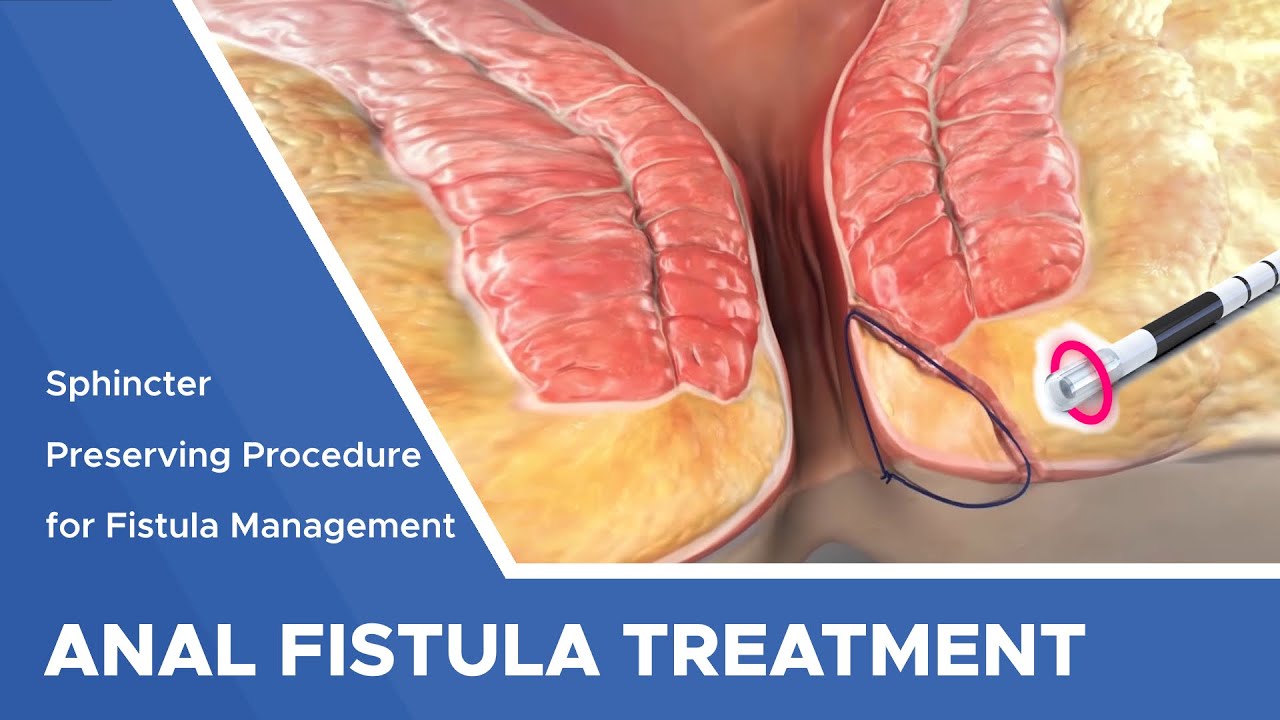 anal fistula treatment