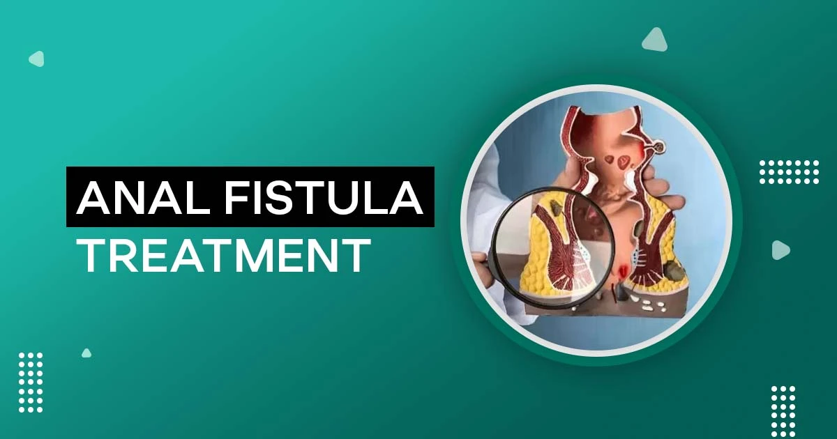 Anal Fistula Treatment