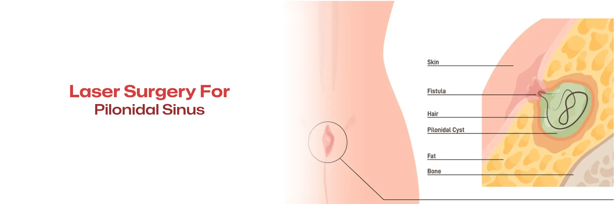 Laser Surgery For pilonidal sinus