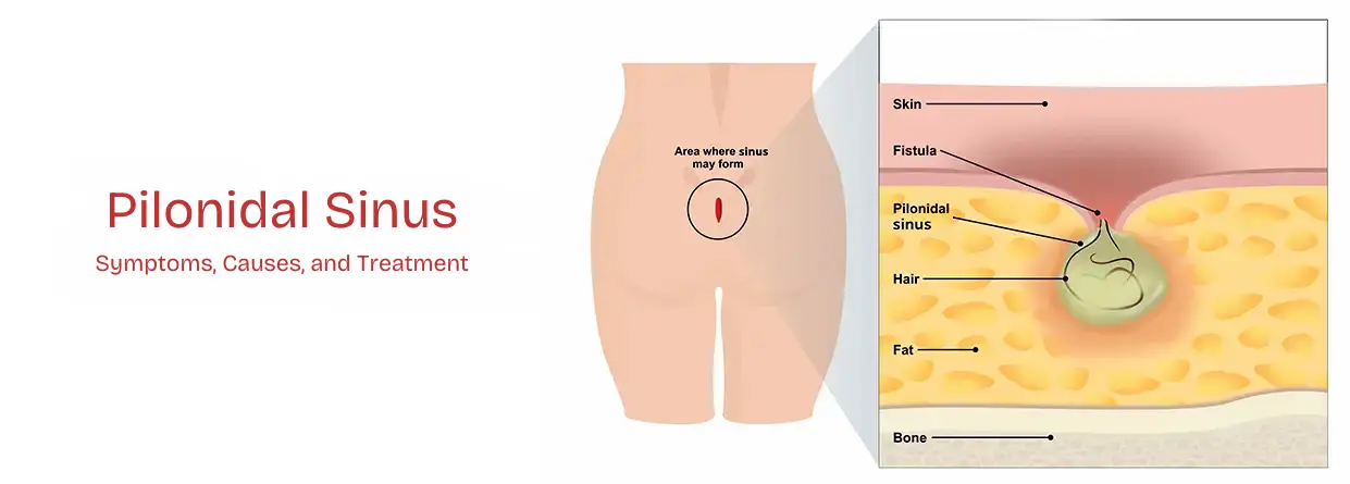 Pilonidal Sinus Laser Treatment in Karachi
