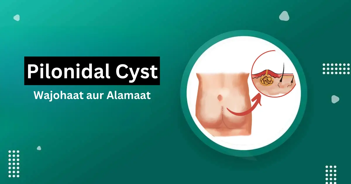 pilonidal cyst