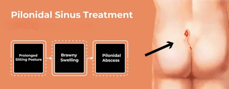 pilonidal cyst meaning in urdu