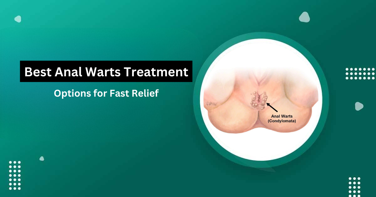 Best Anal Warts Treatment