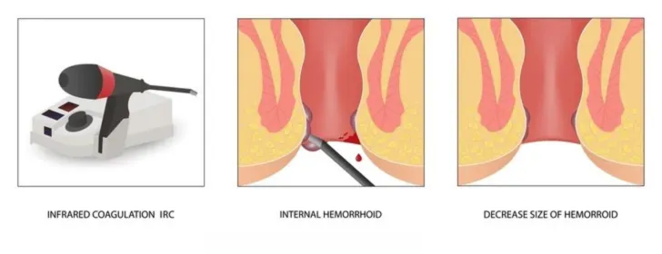 Infrared Coagulation