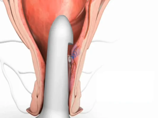Hemorrhoidal Artery Ligation