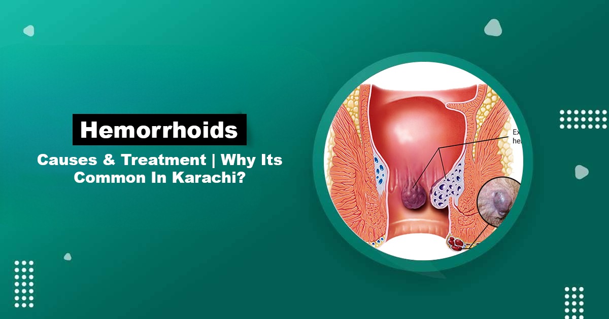 Hemorrhoids