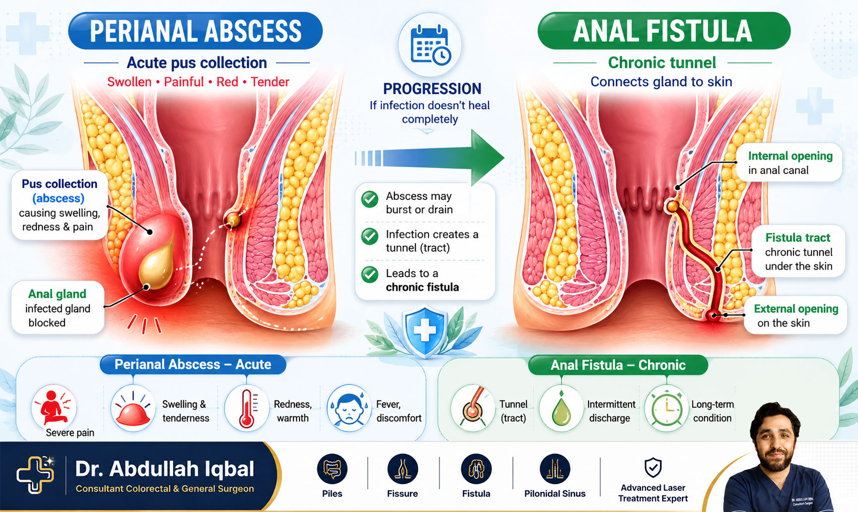 Abscess vs fistula — comparison diagram (acute vs chronic)