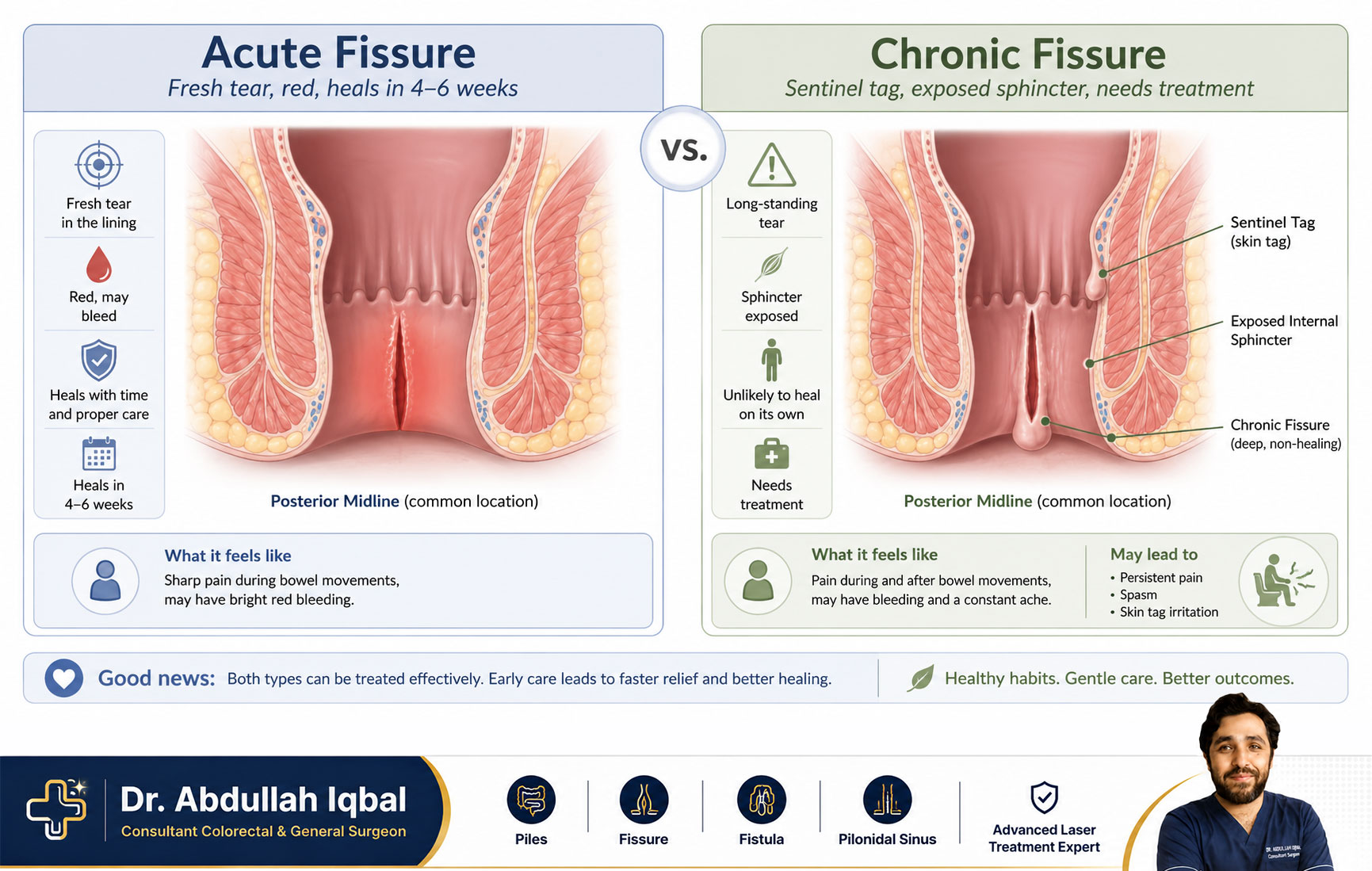 Acute vs chronic anal fissure — treatment differences, Karachi