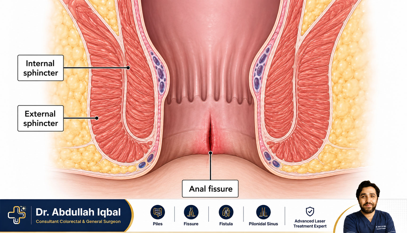 Anal fissure anatomy — tear in the anal canal lining