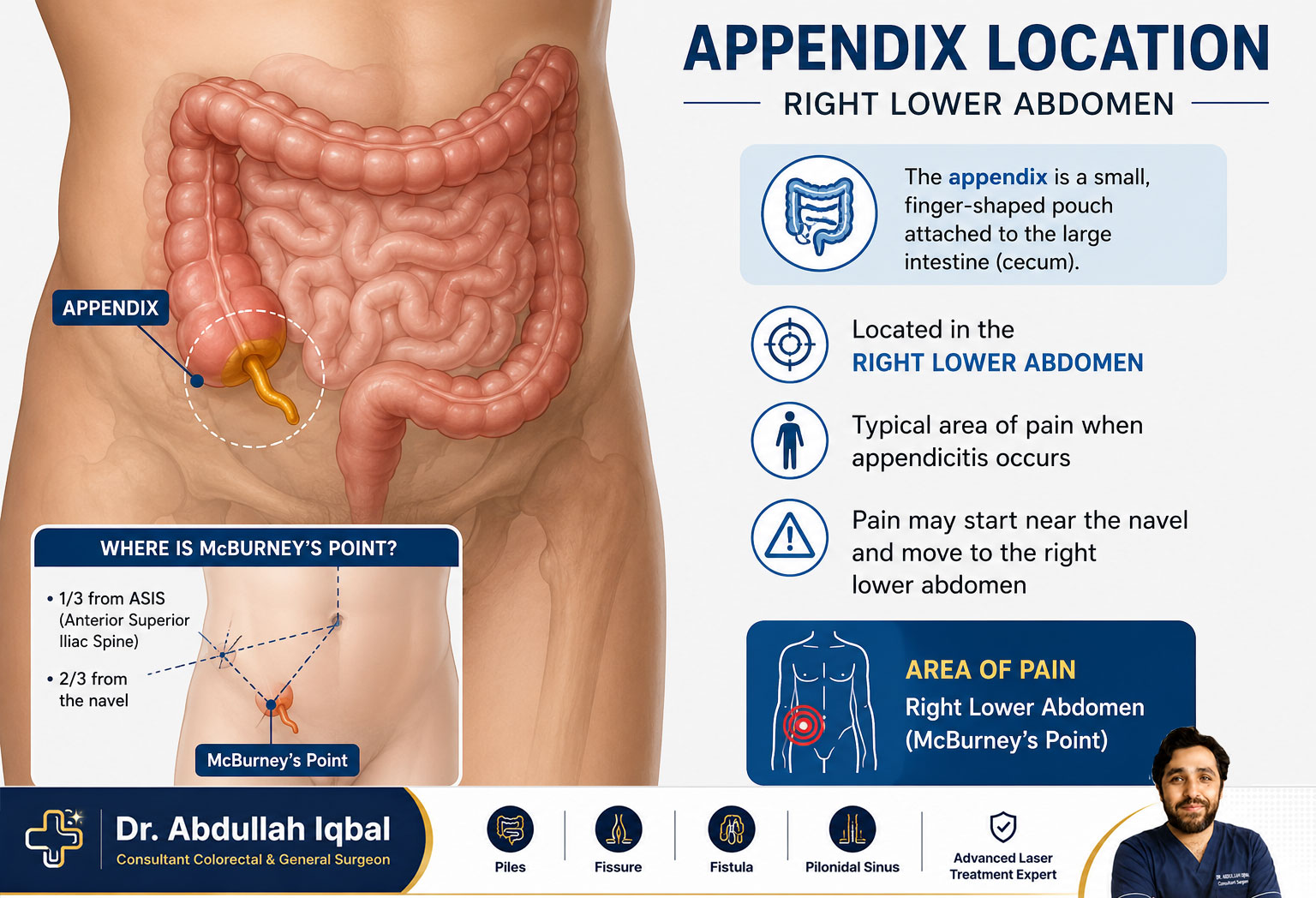 Appendix location diagram — right lower abdomen