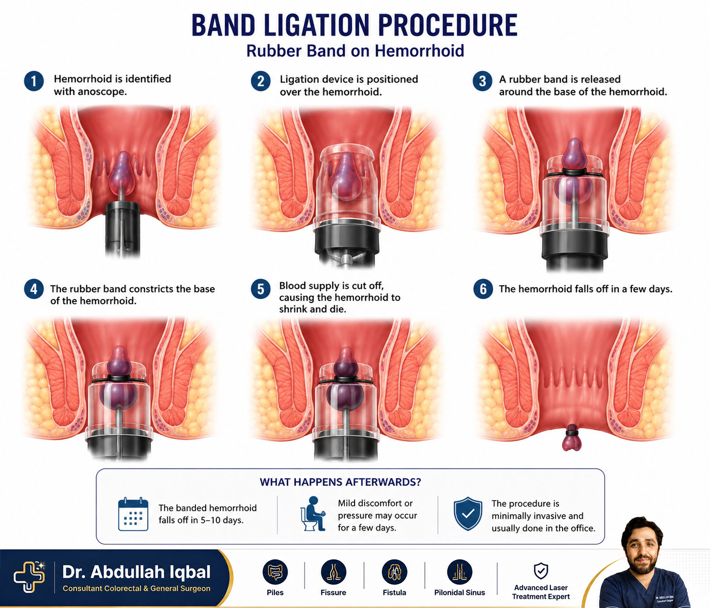 Band ligation procedure — rubber band on a hemorrhoid