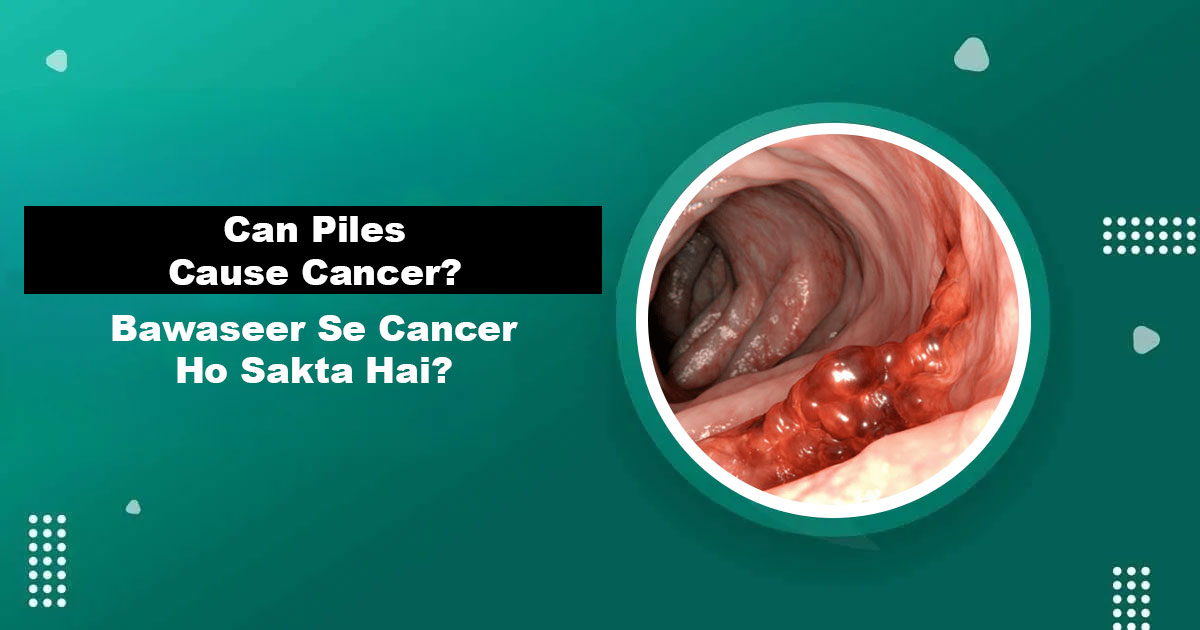 Can Piles Cause Cancer — Bawaseer Se Cancer Risk