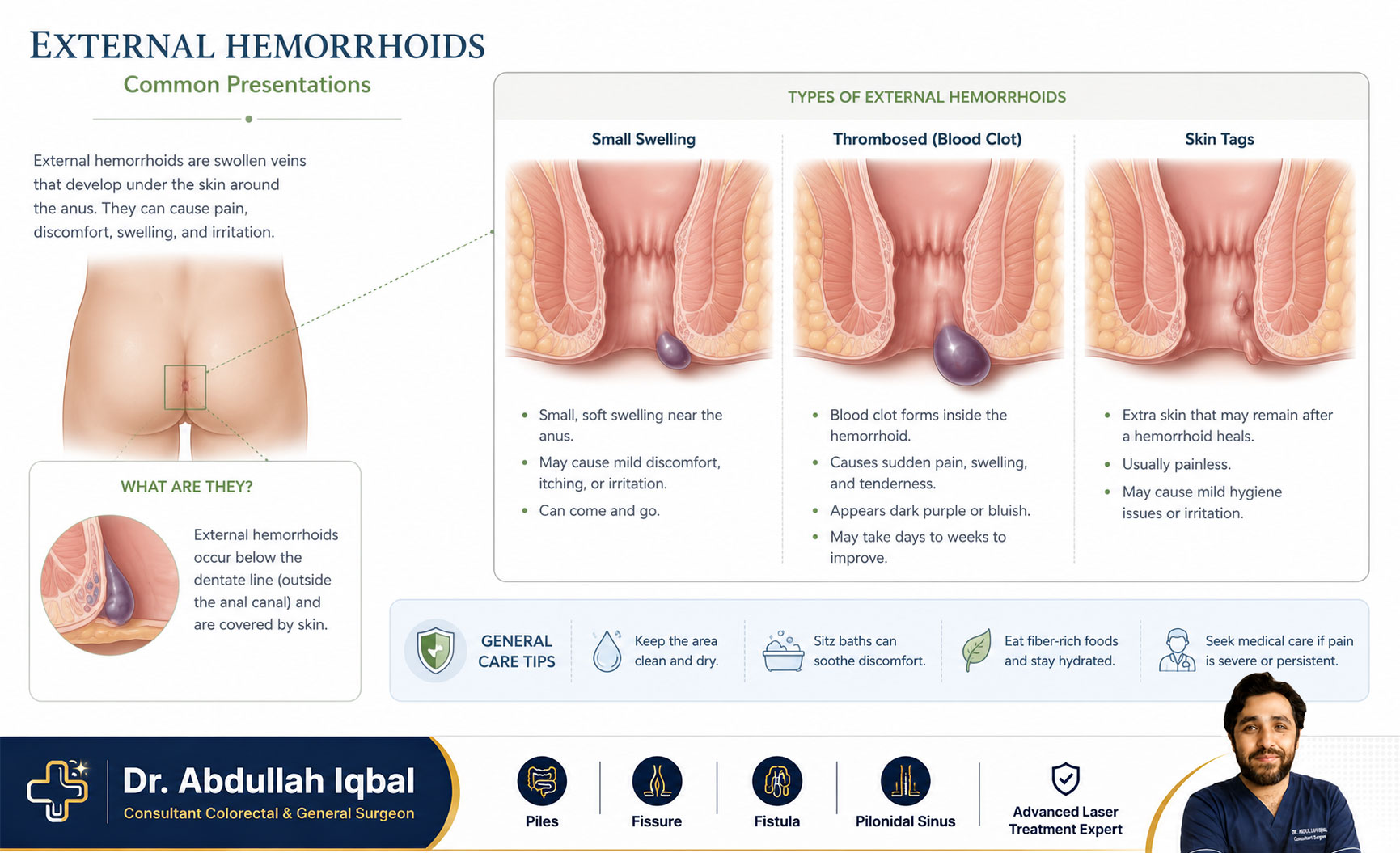 External hemorrhoids appearance — what piles look like