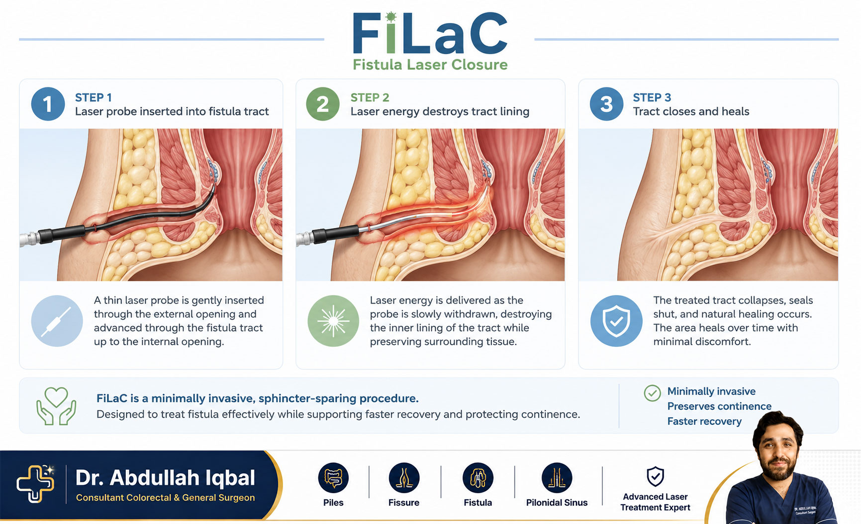 FiLaC laser fistula treatment — step by step