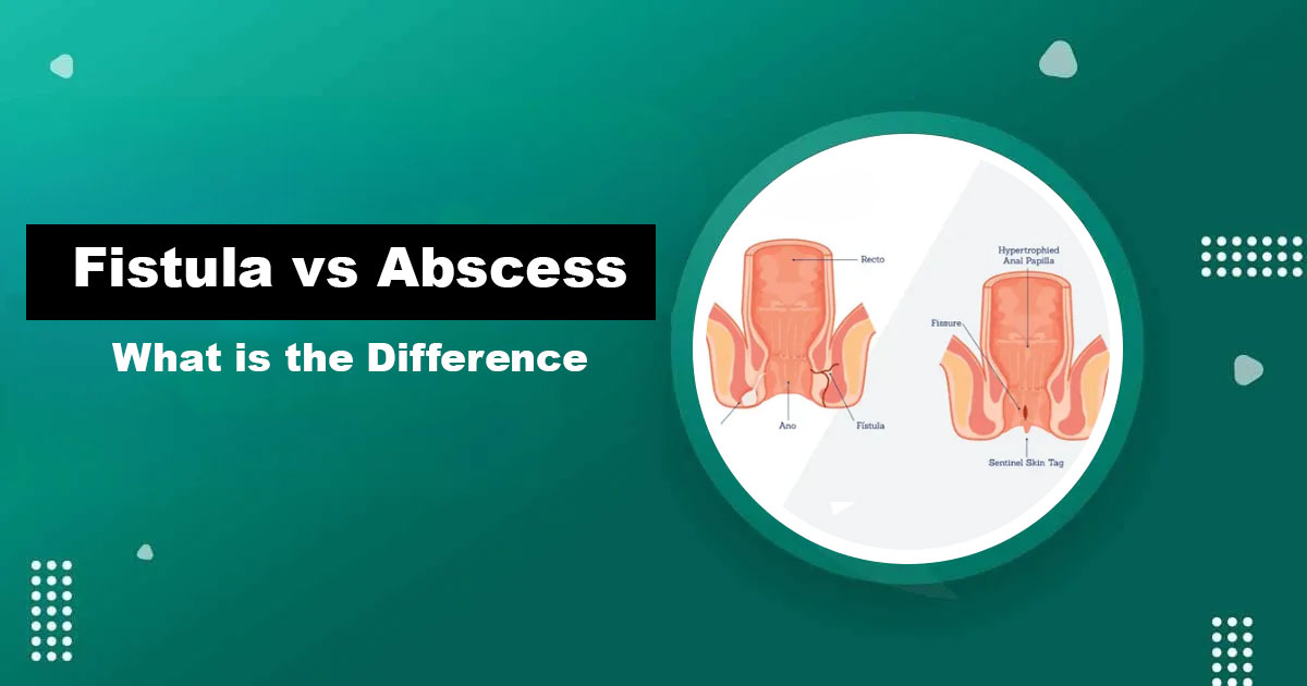 Fistula vs Abscess Difference — Bhagandar Explained