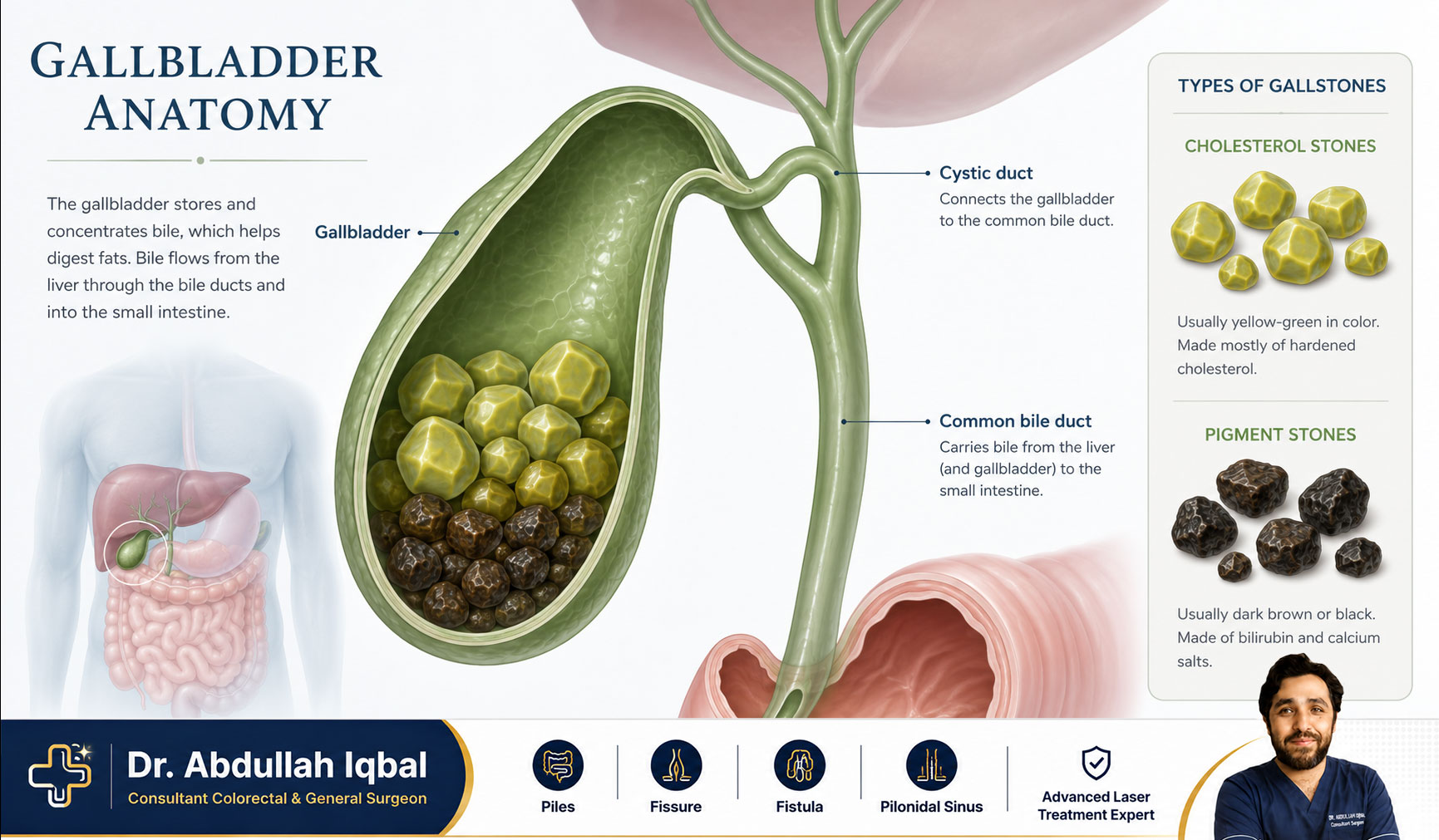 Gallbladder anatomy with gallstones — diagram