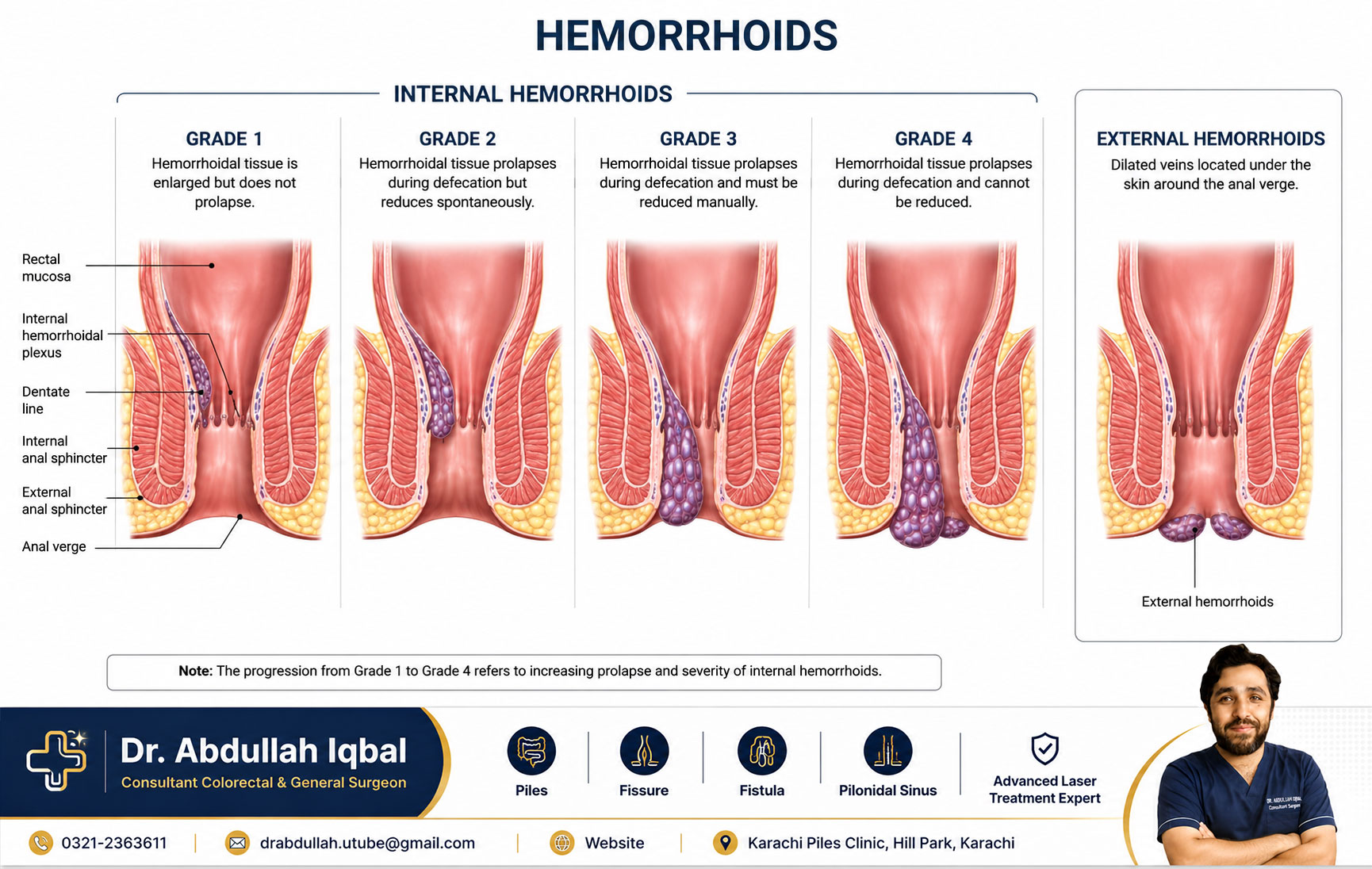 Internal and external hemorrhoids grades — anatomy