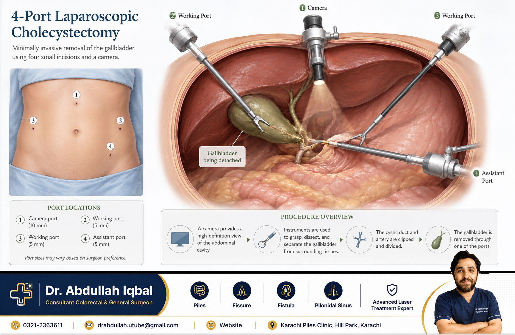 Laparoscopic cholecystectomy — 4-port gallbladder removal