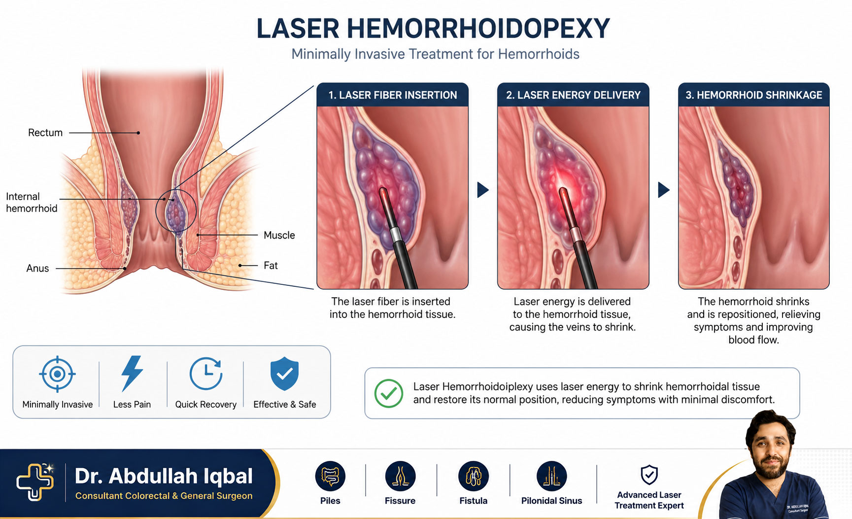 Laser piles treatment procedure illustration