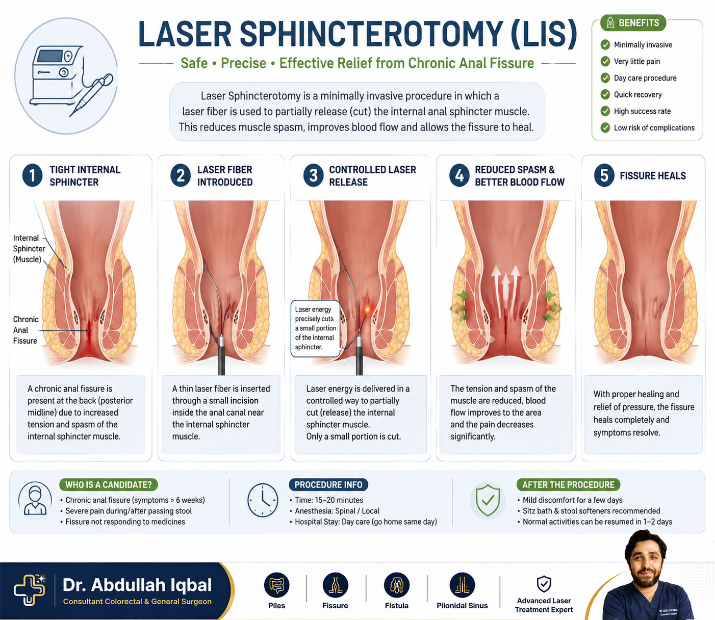 Laser sphincterotomy procedure illustration