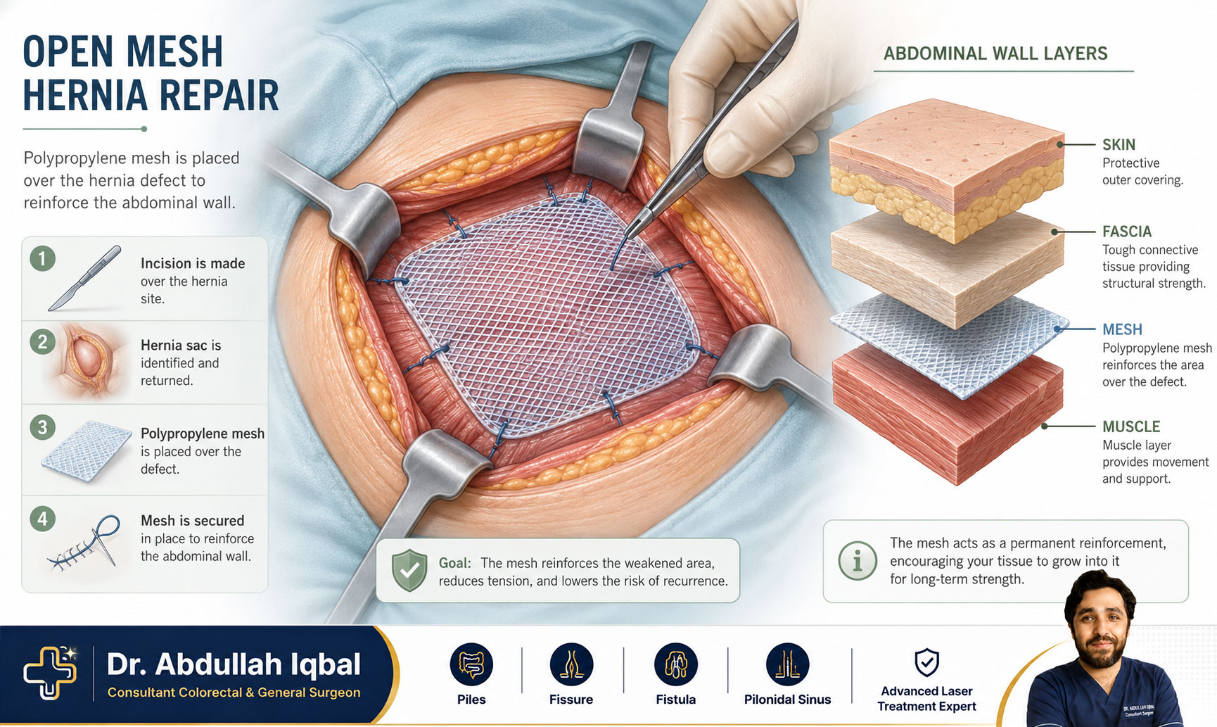 Open mesh hernia repair surgery — procedure