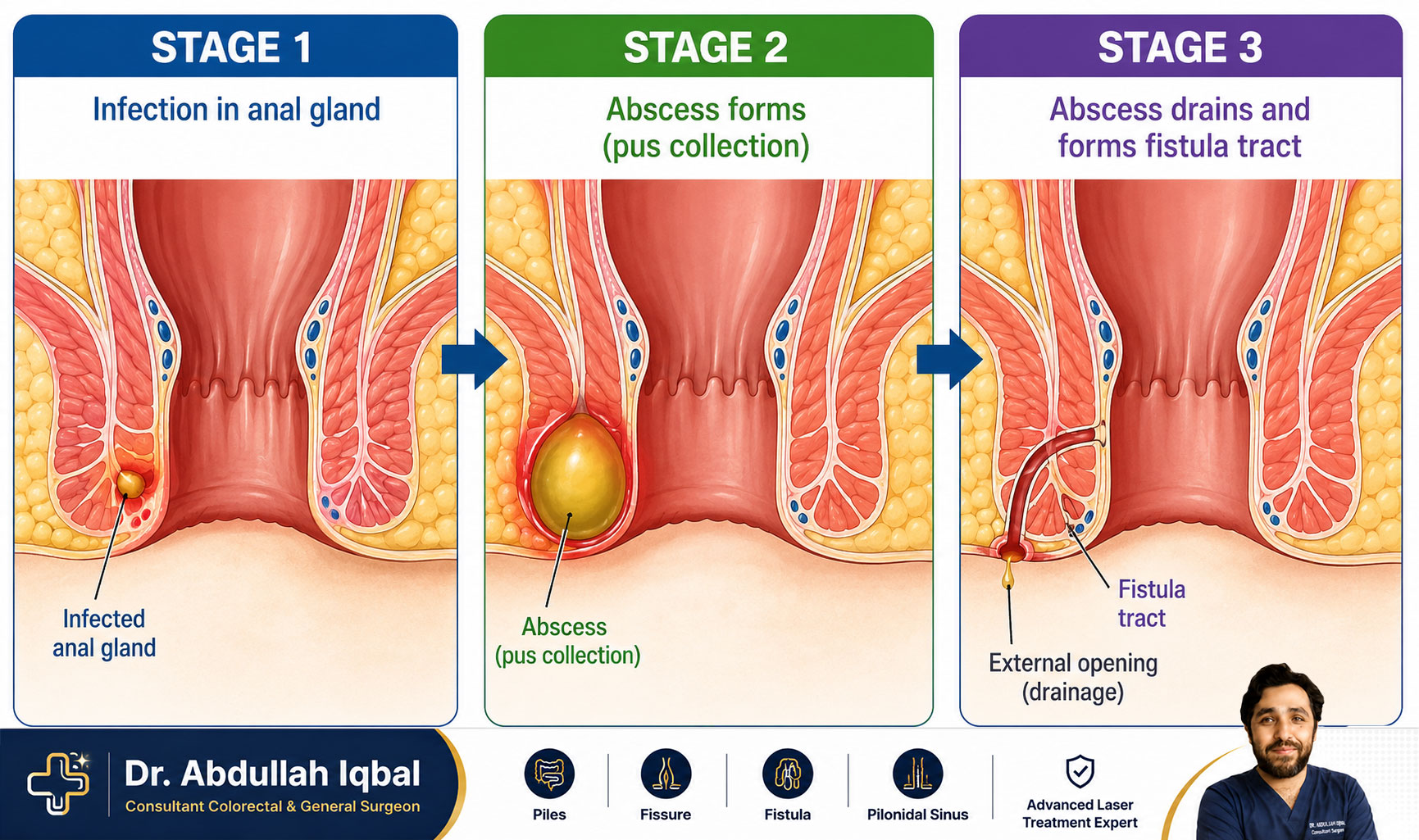 Perianal abscess progressing to anal fistula