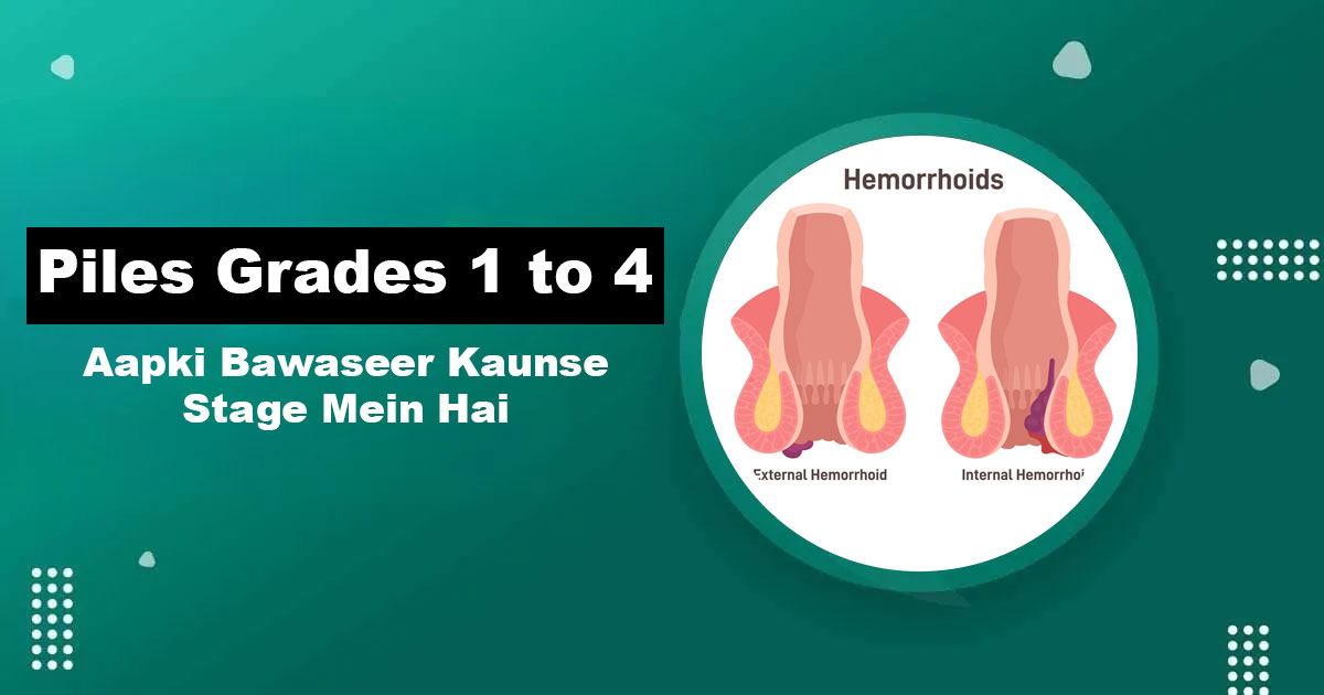 Piles Grades 1 to 4 — Bawaseer Stages Explained