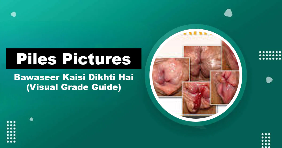 Piles Pictures — Bawaseer Grades Visual Guide Karachi