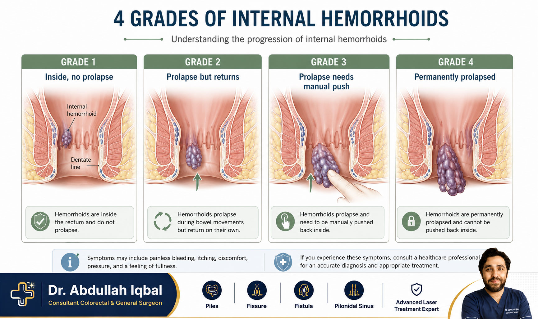 Piles grades 1 to 4 — hemorrhoid stages explained
