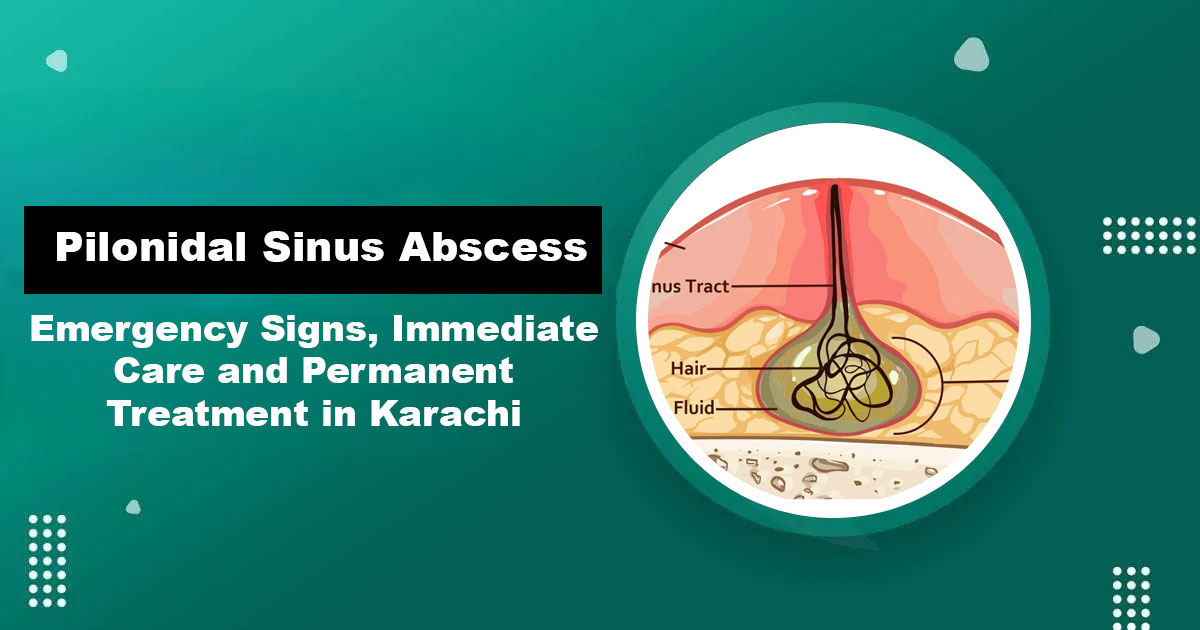 Pilonidal Sinus Abscess Emergency Treatment — Dr. Abdullah Iqbal Karachi