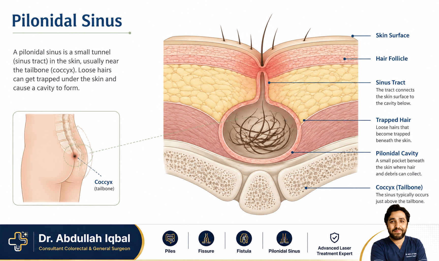 Pilonidal sinus anatomy — location above the tailbone