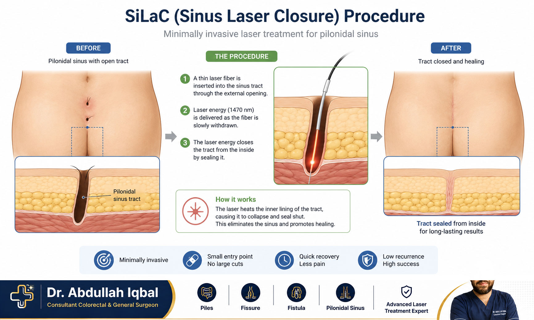 Pilonidal sinus laser closure (SiLaC) procedure