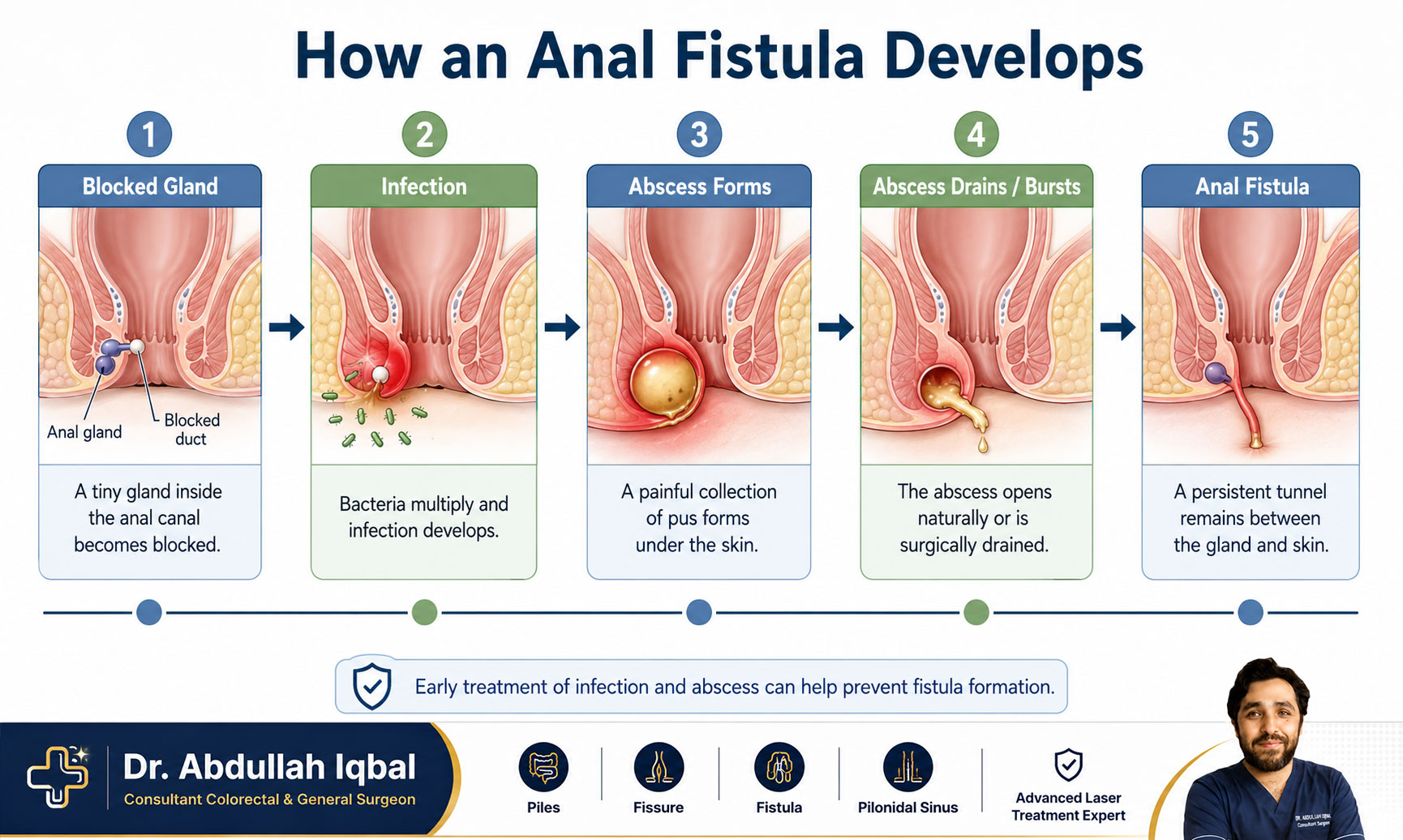 When an abscess becomes a fistula — progression timeline