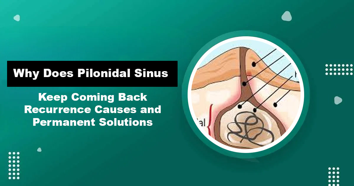 Pilonidal Sinus Recurrence — Causes and Permanent Treatment in Karachi