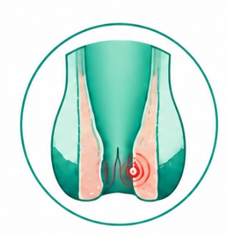 Laser fissure treatment in Karachi