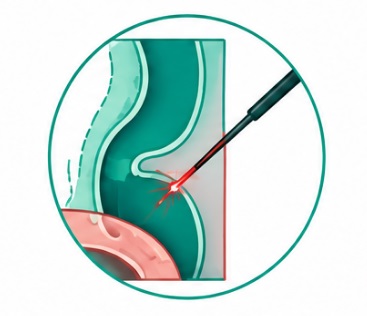 Laser fistula treatment FiLaC in Karachi